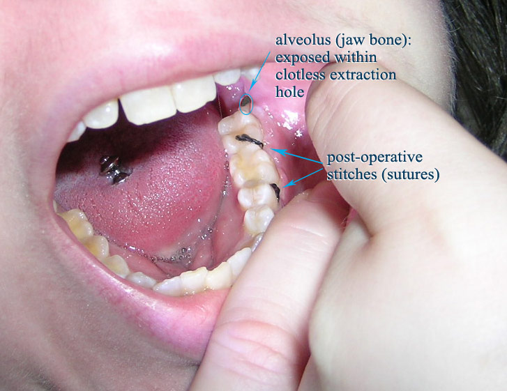 Mouth Open With Labels And Post Operative Stiches Photo 